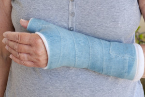Woman's broken arm in cast