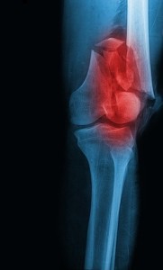 Left leg fracture