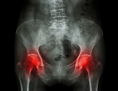 Detecting Bony Abnormalities of the Hip Joint - AnalyzeDirect