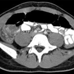 Axial Abdominal CT