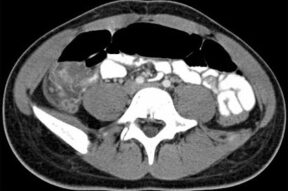 Axial Abdominal CT