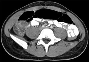 Axial Abdominal CT