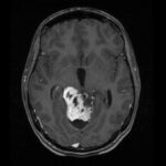 Glioblastoma