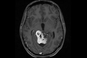 Glioblastoma