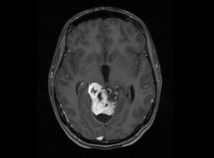 Glioblastoma